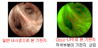 [왼쪽] 일반 내시경으로 본 기관지, [오른쪽] Onco-LIFE로 본 기관지, 적색부분이 기관지 상피