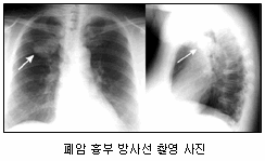 폐암 흉부 방사선 촬영 사진