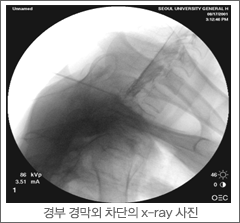 경부 경막외 차단의 x-ray 사진