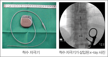 [왼쪽] 척수 자극기, [오른쪽] 척수 자극기가 삽입된 x-ray 사진