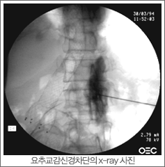 요추교감신경차단의 x-ray 사진