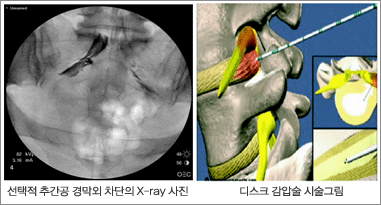 [왼쪽] 선택적 추간공 경막외 차단의 x-ray 사진, [오른쪽] 다스크 감압술 시술그림