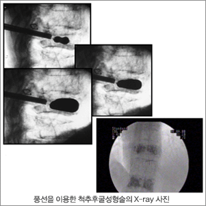 풍선을 이용한 척추후굴성형술의 x-ray 사진