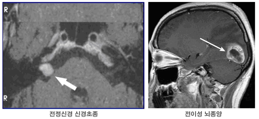 [왼쪽] 전정신경 신경초종, [오른쪽] 전이성 뇌종양