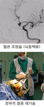 [위] 혈관 조영술, [아래] 정위적 혈종 제거술