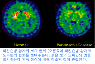 파킨슨병 환자의 뇌의 변화, 오른쪽이 파킨슨병 환자의 도파민의 변화를 보여주는데 붉은 빛의 도파민의 양을 표시하는데 왼쪽 정상에 비해 감소된 것이 관찰된다.