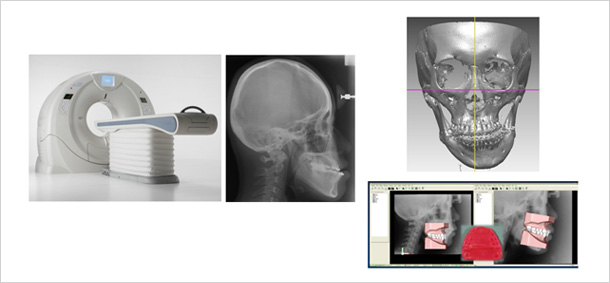 최첨단 디지털 안면골 X-ray와 3차원 CT를 촬영하여 컴퓨터를 이용하여 체계적인 얼굴 형태 분석시행