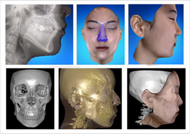 3D 처리된 안면 영상에서 가상 수술 시스템으로 술 후 외모를 예측