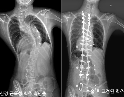 척추측만증 수술 전과 후 참고자료