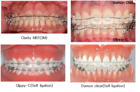 Ceramic bracket »çÁø